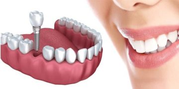 درصد موفقیت ایمپلنت فوری چقدر است