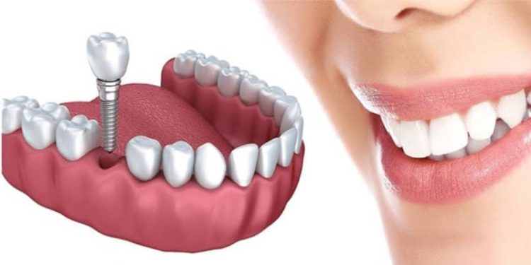 درصد موفقیت ایمپلنت فوری چقدر است ؟ 1 درصد موفقیت ایمپلنت فوری چقدر است