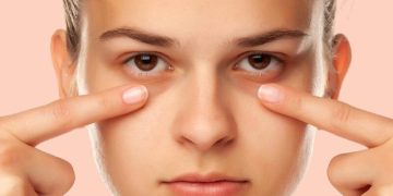 رفع گودی و سیاهی زیر چشم