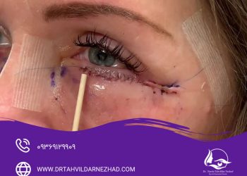 بلفاروپلاستی در مشهد