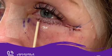 بلفاروپلاستی در مشهد