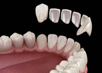 نکاتی برای نگهداری از ونیرهای کامپوزیت