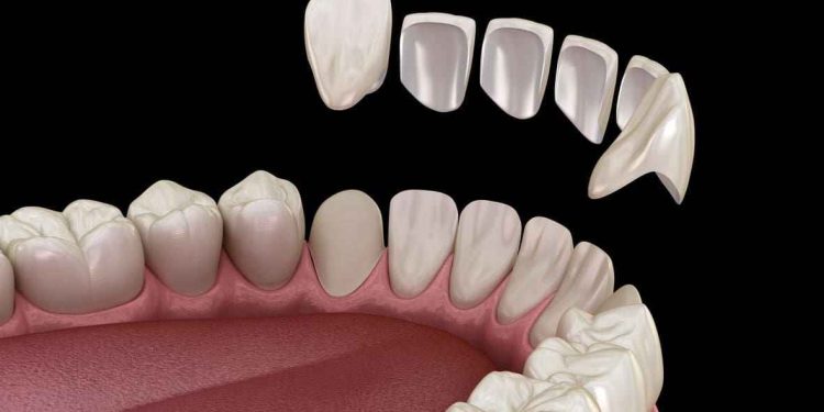 نکاتی برای نگهداری از ونیرهای کامپوزیت