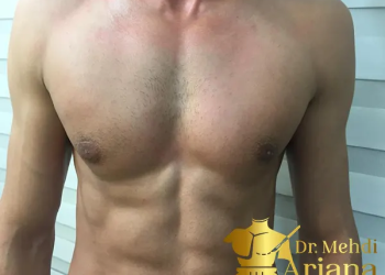 ژنیکوماستی چیست؟ بررسی علل، درمان و هزینه_های جراحی