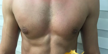 ژنیکوماستی چیست؟ بررسی علل، درمان و هزینه_های جراحی