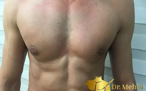 ژنیکوماستی چیست؟ بررسی علل، درمان و هزینه_های جراحی