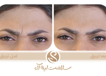 فواید بوتاکس فواید تزریق بوتاکس