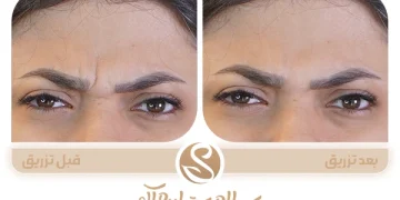 فواید بوتاکس فواید تزریق بوتاکس