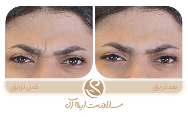 فواید بوتاکس صورت در سال 2025 از نظر متخصصان زیبایی 1 فواید بوتاکس فواید تزریق بوتاکس