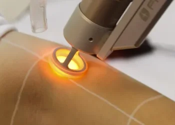 لیزر موهای زائد