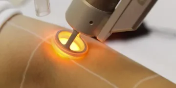 لیزر موهای زائد