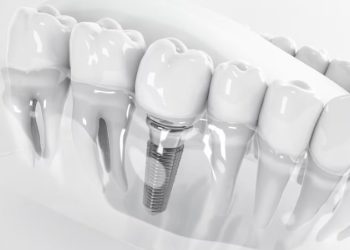 بهترین برندهای  ایمپلنت دندان در جهان