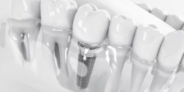 بهترین برندهای  ایمپلنت دندان در جهان
