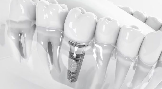 12 تا از بهترین برندهای ایمپلنت دندان در جهان 🦷【سال1404】✅ 1 بهترین برندهای ایمپلنت دندان در جهان