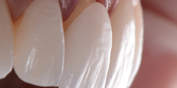 پوسیدگی دندان زیر لمینت