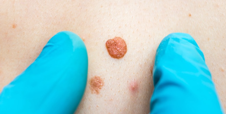 5 تفاوت زگیل تناسلی با دیگر بیماری های پوستی ❤【سال1404】⭐ 1 ۵ تفاوت زگیل تناسلی با دیگر بیماری های پوستی