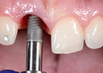 ۸ عاملی که باعث شکستن ایمپلنت دندان می_شود