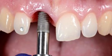 ۸ عاملی که باعث شکستن ایمپلنت دندان می_شود