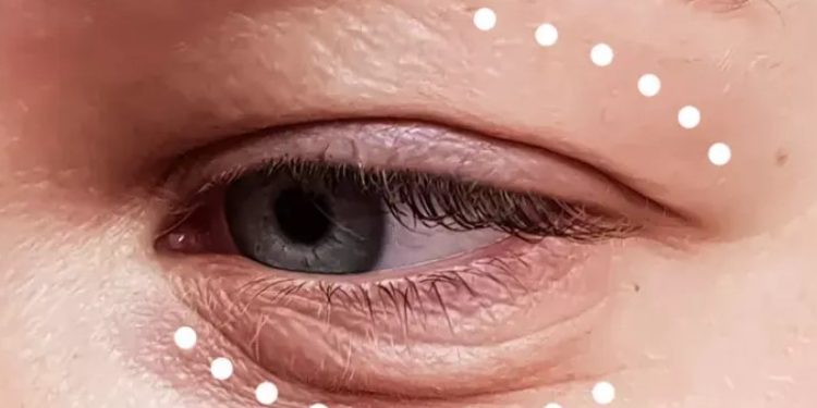 تاثیر لیفت ابرو بر بهبود میدان دید + بررسی کامل 1 تاثیر لیفت ابرو بر بهبود میدان دید