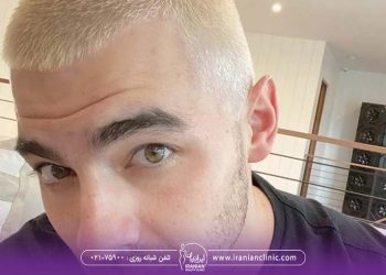 آیا دکلره باعث ریزش مو می شود