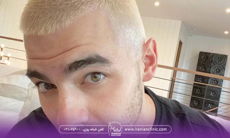 آیا دکلره باعث ریزش مو می شود