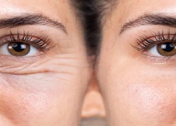 خوبی و بدی های جراحی بلفاروپلاستی چشم _ مزایای جراحی پلک