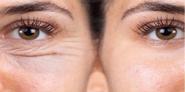 خوبی و بدی های جراحی بلفاروپلاستی چشم _ مزایای جراحی پلک