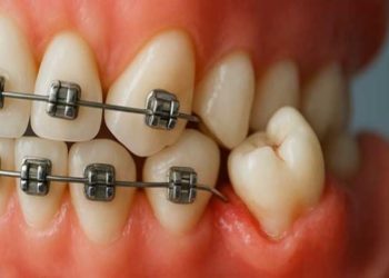 آیا برای ارتودنسی باید دندان عقل را کشید؟ 10 تاثیر دندان عقل بر ارتودنسی