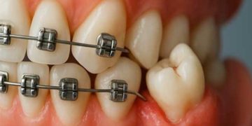 تاثیر دندان عقل بر ارتودنسی