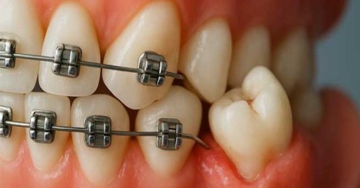 آیا برای ارتودنسی باید دندان عقل را کشید؟ 1 تاثیر دندان عقل بر ارتودنسی