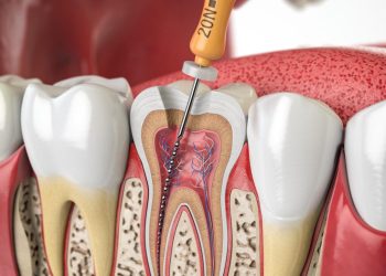 قیمت عصب کشی دندان شماره 6 - قیمت عصب کشی دندان