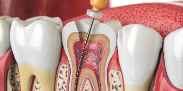 قیمت عصب کشی دندان شماره 6 - قیمت عصب کشی دندان