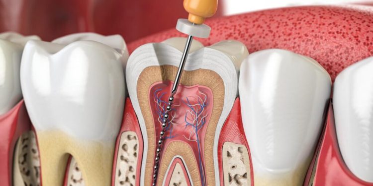 قیمت عصب کشی دندان شماره 6 - قیمت عصب کشی دندان 1 قیمت عصب کشی دندان شماره 6 - قیمت عصب کشی دندان