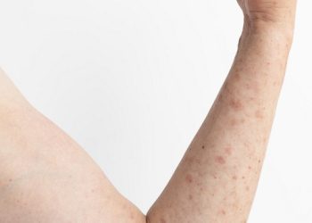 علت خارش بعد از لیزر چیست؟بررسی عوامل،مراقبت ها و نکات تخصصی 6 علت خارش بعد از لیزر چیست