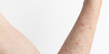 علت خارش بعد از لیزر چیست