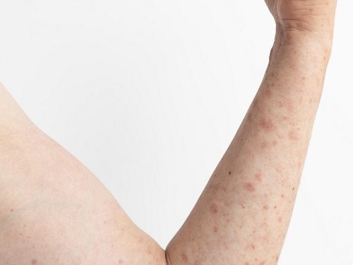 علت خارش بعد از لیزر چیست؟بررسی عوامل،مراقبت ها و نکات تخصصی 1 علت خارش بعد از لیزر چیست