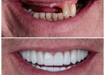 بهترین روش برای ترمیم و زیبایی دندان