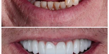 بهترین روش برای ترمیم و زیبایی دندان