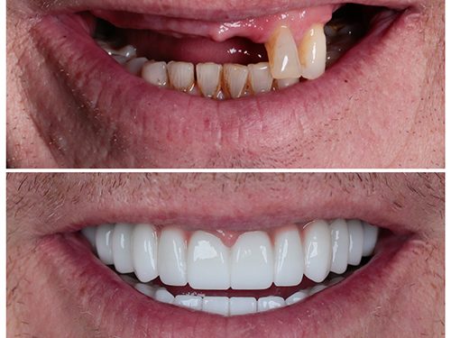 بهترین روش برای ترمیم و زیبایی دندان