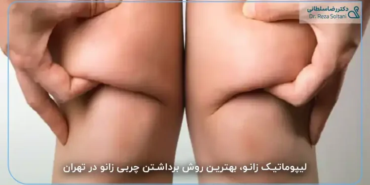 لیپوماتیک زانو