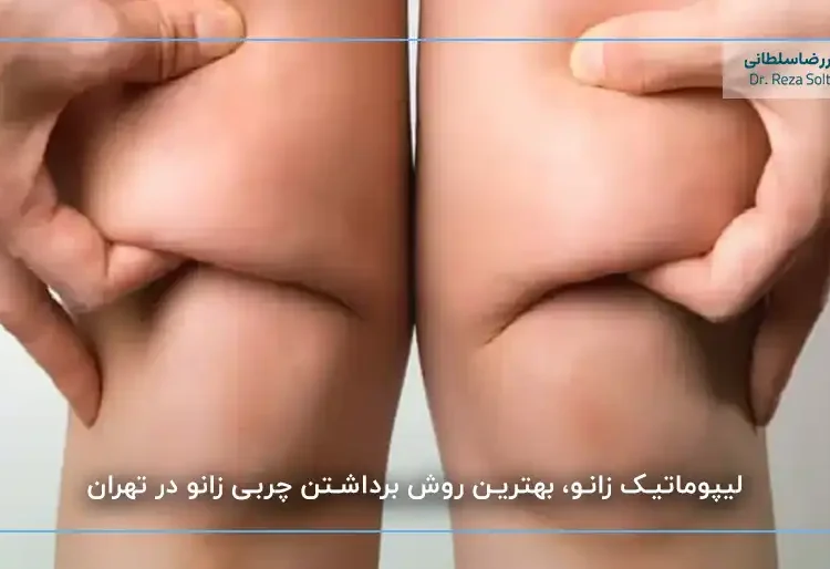 مراقبتهای بعد از جراحی زانو: نحوه صحیح خوابیدن و استراحت 23 لیپوماتیک زانو