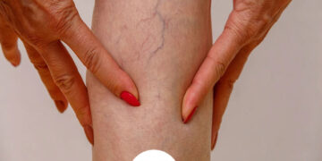 چرا واریس پا بعد از درمان دوباره برمی‌گردد؟