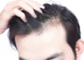 اوج ریزش مو در چه سنی است؟