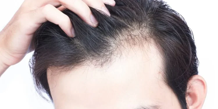 اوج ریزش مو در چه سنی است؟