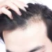 اوج ریزش مو در چه سنی است؟ 5 اوج ریزش مو در چه سنی است؟