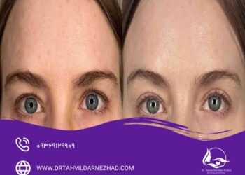 8 تفاوت اصلی بلفاروپلاستی با جراحی لیفت ابرو؛ بررسی هدف، روش، ماندگاری و دوره نقاهت 6 تفاوت بلفاروپلاستی با لیفت ابرو