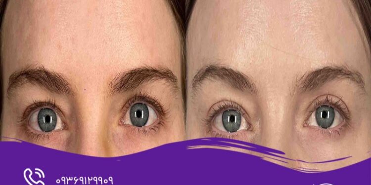 8 تفاوت اصلی بلفاروپلاستی با جراحی لیفت ابرو؛ بررسی هدف، روش، ماندگاری و دوره نقاهت 1 تفاوت بلفاروپلاستی با لیفت ابرو