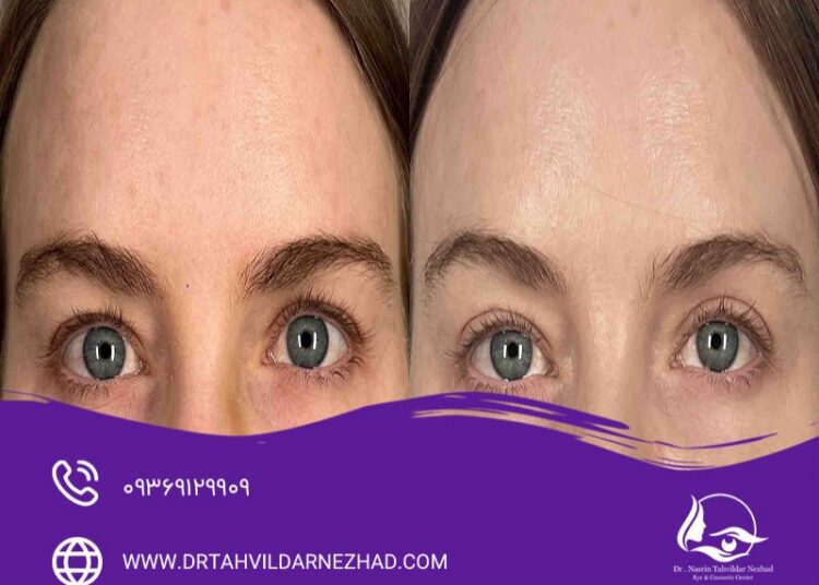 8 تفاوت اصلی بلفاروپلاستی با جراحی لیفت ابرو؛ بررسی هدف، روش، ماندگاری و دوره نقاهت 23 تفاوت بلفاروپلاستی با لیفت ابرو